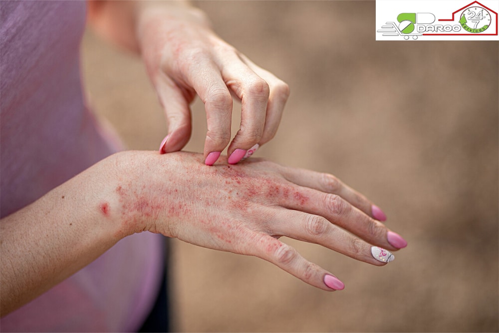 اگزما پوستی چیست؟ علت پیدایش و روش درمان اگزما پوستی